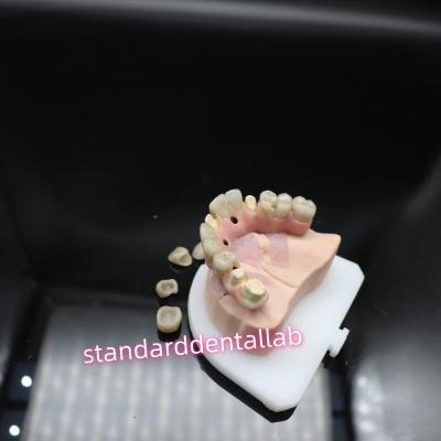 China Puente de implantes dentales digitales de titanio Ivoclar Hybrid Puente de zirconia en venta