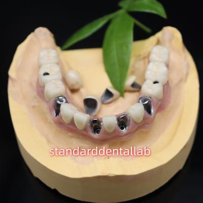 China Screw Retained Dental Implant Metal Ceramic Crowns Malo Bridge for sale