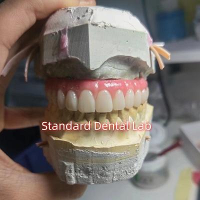 China Screw Retained Titanium PMMA Dental Bridge Temporary Crown for sale