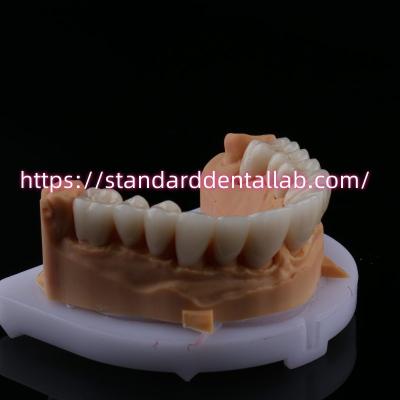 China FDA High Esthetics Dental Zirconia Bridge met gelaagde porseleinen circonia tandkronen China Dental Lab Te koop