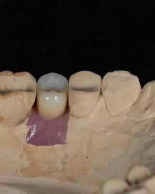 Cina Impianto di cemento a vite per impianti dentali di lunga durata con garanzia di 5 anni in vendita