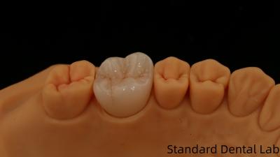 China Noritake porcelana de contorno completo coroa de zircônio personalizado sombra de vita para estética digital restauração dentária por laboratório dentário à venda