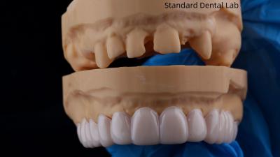 China High Esthetics Dental Snap On Smile Standard Dental Lab Removable Dental Appliance for sale