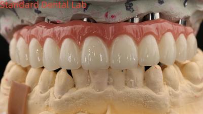 China Porcelana todo en cuatro puente de zirconia alta estética puente de implantes dentales tornillo retenido en venta