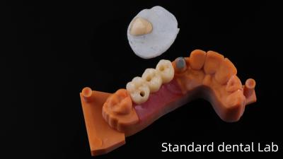 Cina Post Core Dental Lab dalla Cina / Metal Post Core con corona PFM in vendita