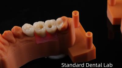 China Schroef vastgehouden tandheelkundige implantaat kroon met PFZ porseleinen gelaagd zirconia 5 jaar garantie en 3D print model Te koop