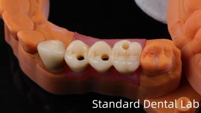 China Implante dental de zirconio profesional corona de titanio CAD CAM corona de zirconio China laboratorio dental en venta