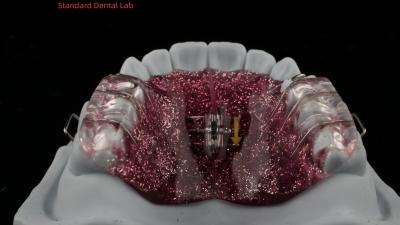 Chine Expansion et distillation des dents ajustement d' un expansateur dans la bouche d' un orthodontiste d' un expansateur de palais à vendre