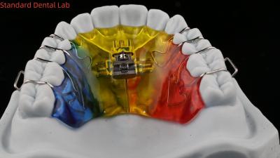 China Tandvergroting en distillatie Orthodontist Palate Expander China Tandheelkundig Lab Te koop