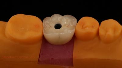 China Coroa de implante dental de zircón de porcelana con capas de PFZ retenido por tornillo de laboratorio dental ISO FDA CE certificado con garantía de 5 años en venta