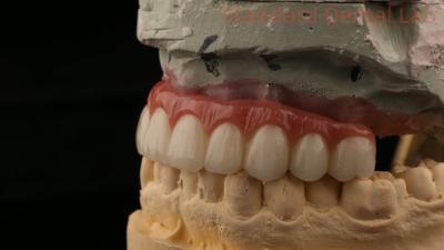 China Implantação dentária de titânio híbrido parafuso retido coroa todos em 4 Implantação dentária Zirconia ponte à venda