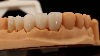 Chine Des dents antérieures de haute esthétique à contour complet couronne de zirconium avec laboratoire dentaire Vita Shade personnalisé à vendre