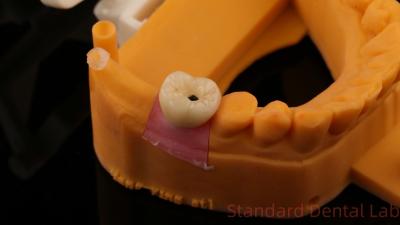 China Dental Implantat Schraube Korone PFZ Porzellan Schicht Zirkonia mit 3D-Druck Modell zu verkaufen