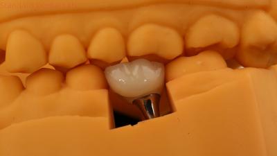 China Screw Retained Dental Implant Crown Dental PFM Crown With 3D Print Model for sale