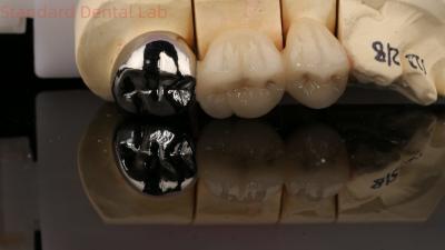 China Vita Porcelian Full Metal Crown With Post Core 3 Years Guarantee from Dental Lab for sale