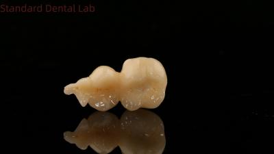 Китай Стоматологическая цифровая цирконовая корона с 3D-печатью SDL Dental Lab Zirconia Onlay продается