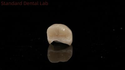 China Translucidez Dental Corona de Zirconia Inlay Corona Onlay para restaurar la forma natural de la cavidad en venta