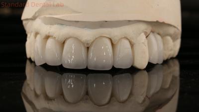 China China Dental Lab Zirconia Full Contour Crown High Aesthetic Natural Dental Bridge 5 jaar garantie Te koop