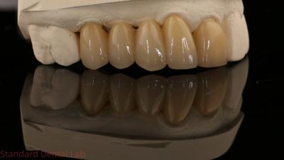 China Noritake Porselein Full Contour Zirconia Kroon Hoog Esthetisch Natuurlijke Op maat gemaakte Zirconia Tandbrug Te koop