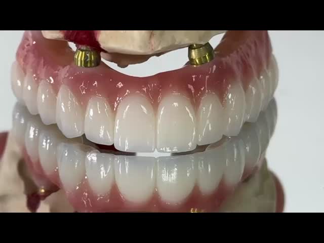 Dental All On X Implant PFM Crown Titanium Fixed Hybrid Denture