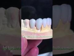 Natural looking Emax Veneers Crown Biocompatibility Bleaching Shade with Minimal Preparation