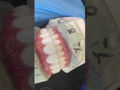 Dental Implant Crown