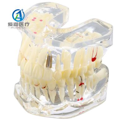 China High Quality Caries Model Multifunctional Educational Supplies Dental Model for Patient Teaching for sale