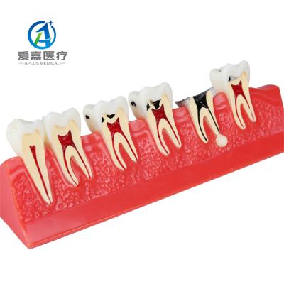 China Detailed Human Structures Selling Best For Education Dental Putty Tooth Treatment Caries Model for sale