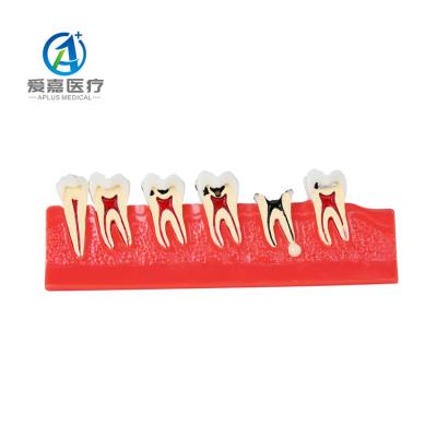 China Detailed Human Structures Caries Treatment Demonstration Best Selling Model For Quick Delivery for sale