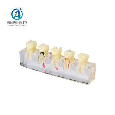 China Detailed Hot Sale Human Tooth Plant Structures Root Canal Dental Endodontic Model For Study for sale