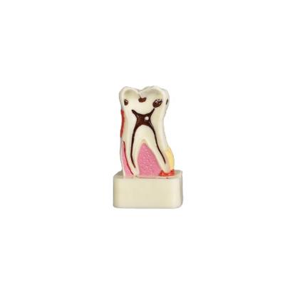 China Detailed Human Structures 4 Times Hot Selling Anatomy Pathological Teeth Model With Fast Shipment for sale