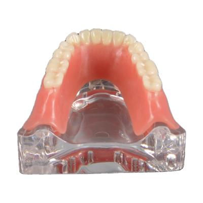 China Clear Model Silver Bar Restoration Display Structure Implant Jaw Lower Jaw With Implant Teeth Model for sale