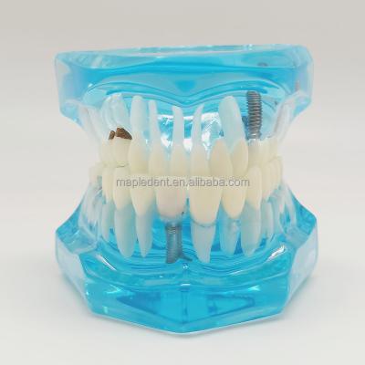 China Dental Implant Model Dental Decoration Resin Regional Study Teeth Model For Demonstration for sale