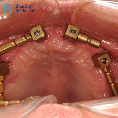 Cina Corpo di scansione multiunitario in oro in titanio CAM System Corpo di scansione dentale in vendita