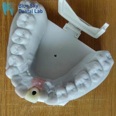 Chine Stérilisation à la vapeur Couronne d'implant simple Couronne d'implant dentaire à surface lisse à vendre