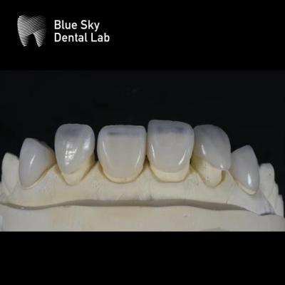 China Casos de Veneers Ultrafinos e Elegante 0,3mm Veneers Personalizados Mais Finos à venda