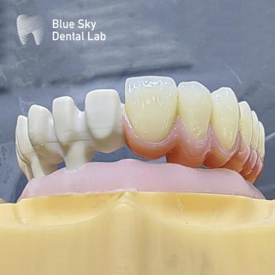 China Personaliza los casos de implantes de color con diseño natural de superficie lisa para la compatibilidad universal en venta