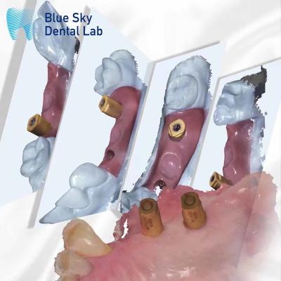 China Scan Body All In One Dental Healing Capsule Sistema de Implante Blue Sky à venda