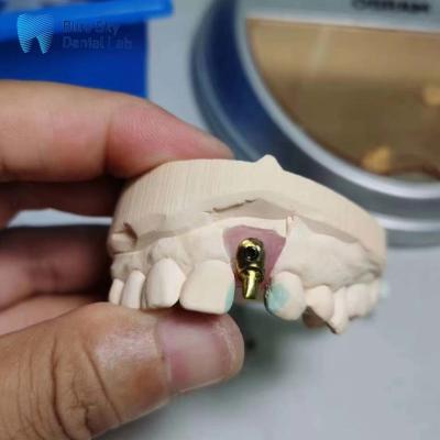 China Casos de implantes regulares con implante dental individual personalizable Casos de implantes de arco desplazado en venta