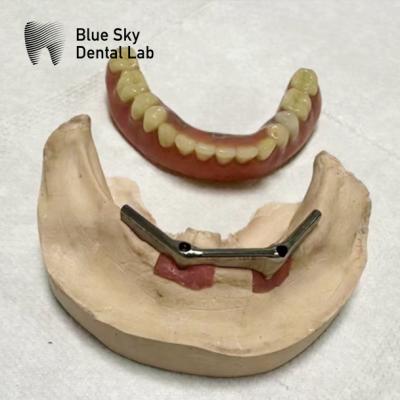 China Implante Dental con prótesis extraíble en venta