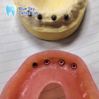 China Restauración de implantes extraíbles Localizador de implantes Dentadura completa Restauración de la boca en venta