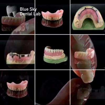 China Barras de Titânio Dental Universal Personalizadas Com Dentadura Acrílica à venda