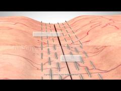 Endoscopic linear cutting stapler introduction of Miconvey